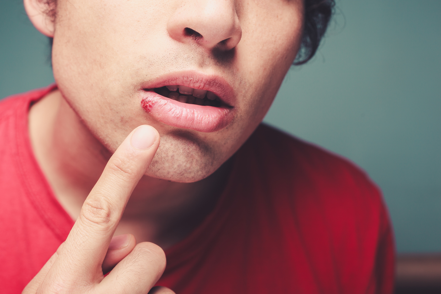 Cold Sore Symptoms to Know