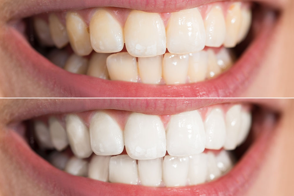 Tips to Whiten Teeth at Home